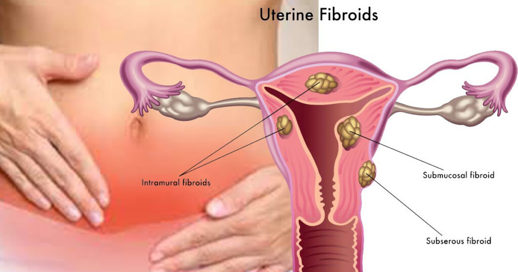 Types of uterine tumors
